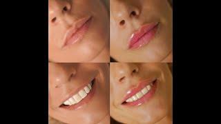 Korekcija usana - RADIANT fileri (before after lip fillers) - klinika S tetik Banja Luka