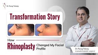 Patient Testimonial about Rhinoplasty | Best Plastic Surgeon in Mumbai | Designer Bodyz