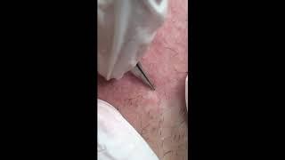 Electrolysis hair removal close up