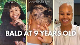 finally telling the truth | MY STORY | How I got alopecia at 9 +  I'll never have hair again?