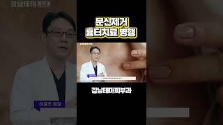 문신제거 흉터치료 병행하면 더 좋은 효과 #문신제거#문신흉터