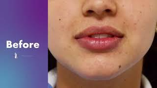 Lip Augmentation: Before and After Hyaluronic Acid Fillers