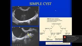 International Cancer Imaging Society Course Oct 17.  Incidental adnexal masses, Gabriele Masselli