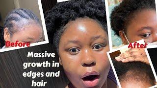 How to grow your edges faster| How to treat Aloepecia quickly| Hair loss  #Edgeentity #naturalhair