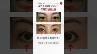 하안검수술로 교정되는 4가지는 무엇?!