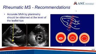ASE Guideline: Recommendations for the Use of Echo in the Evaluation of Rheumatic Heart Disease