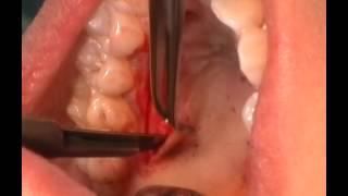 Connective Tissue graft harvesting