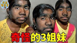 世界最慘3姐妹，臉上長滿毛髮被嘲怪物，沒人願意娶她們回家｜多毛症｜明星觀察員