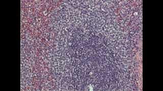 Follicular Lymphoma (in a spleen!)