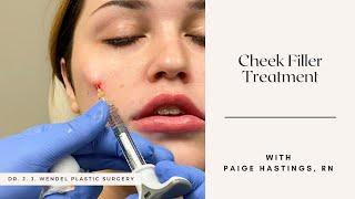 Cheek Filler Treatment | Dr. J. J. Wendel Plastic Surgery | Nashville