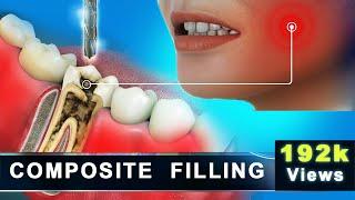 Composite Filling | Molar Cavity Filling with Composite | Advance 3D Dental Animation