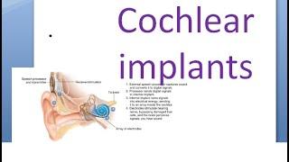 ENT Cochlear implants electrode array multiple channels scala tympani complications