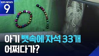 병원 실려온 아기 엑스레이 찍었더니…뱃속에 ‘자석 33개’ [9시 뉴스] / KBS  2025.06.18.