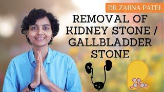 Removal of Kidney Stone / Gallbladder Stone By Dr. Zarna Patel (NDS) | New Diet System
