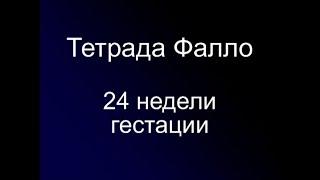 Тетрада Фалло у плода, пренатальная диагностика в 24 недели гестации.