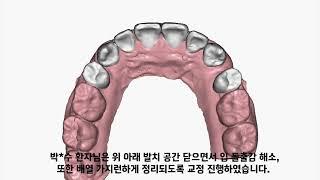 D1 Dental 디원치과 아미절라인 투명교정 박*수 님 케이스리포트