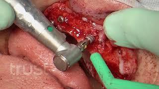 Dental implant surgery. High-quality video from a real surgery