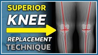 New game changing knee replacement technique explained - "Kinematic" knee replacement