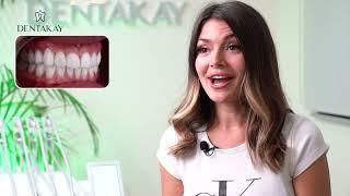 Mrs Iva got her Hollywood smile makeover with Dentakay in Turkey