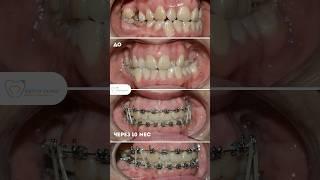 Брекеты до и через 10 мес, подробнее в описании  #брекетымосква #ортодонтмосква
