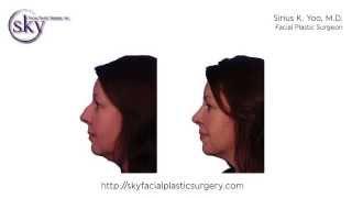 San Diego Rhinoplasty - Bump Removal - SKY Facial Plastic Surgery