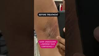 Dark underarms killing your confidence | Dr Ashima Goel| Dermatologist |Chandigarh|Mohali #shorts