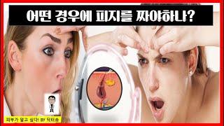 어떤경우에 피지를 제거해야하나?/피지를 짜야하는 경우/피지를 압출해야하는경우