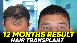 Hair Transplant in Salem | Best Results & Cost of Hair Transplant in Salem