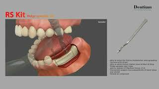 Dentium RS Kit