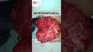 Retroperitoneal Liposarcoma Excision By Agastya Oncology, Surat.