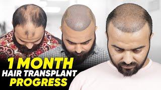 Hair Transplant in Kota | Best Results & Cost of Hair Transplant in Kota