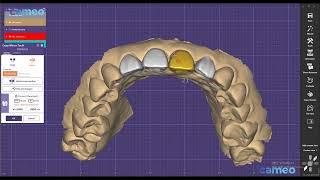 Aidite Exocad design guide: Anterior teeth bridge design