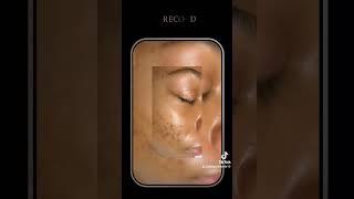 Looking for clear & flawless skin? Check our customer results  LetsWork 