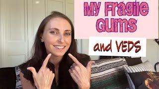 My Fragile, Receding Gums with VEDS (Vascular Ehlers-Danlos syndrome)