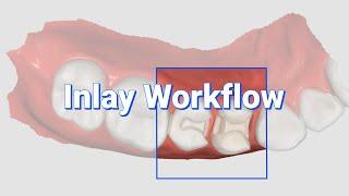 Inlay Workflow