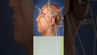 Brain Electrical Activity EEG ° ElectroEncephaloGram