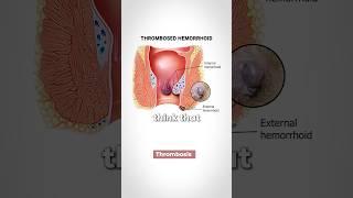 Hemorrhoids! What is the Cause?