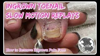 Pedicure Tutorial: How to Remove Ingrown Toenail + Satisfying Slow Motion ⭐