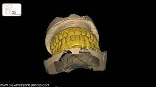 Designing Full Mouth Implant Bridges with Precision and Care with exocad