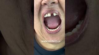 When a tooth falls out this is the best #mrdent -#dentist #smile #dentalesthetics #dentures