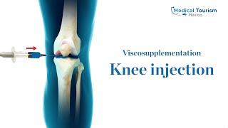 Knee injection procedure - Medical Tourism Mexico