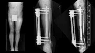 440.(의사용.Case discussion.008. 1/2) Correction of Leg length discrepancy. 하지 부동: 다리 길이 교정 [강찬.충남대]