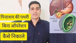 पित्ताशय की पथरी बिना ऑपरेशन कैसे निकाले । Gallbladder stone #shorts