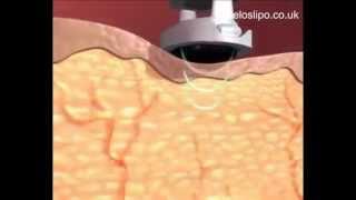 How Ultrasonic Cavitation Works