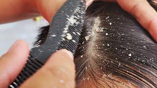 Dandruff Removal At home Part 6