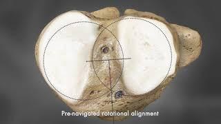 iTotal G2 Knee Implant Fit Animation | Conformis