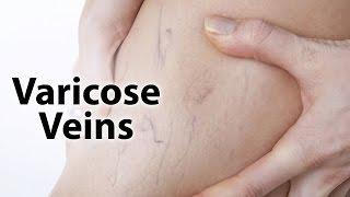 What is Varicose veins | Zyropathy | Care world tv