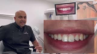 Invisalign Lite, Gum Contour, Bonding and whitening