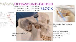 Ultrasound-Guided Sphenopalatine, Pterygopalatine, Trigeminal Nerve Gasserian Ganglion Blocks