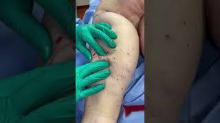 LIPEDEMA NODULES & MANUAL EXTRACTION on Lipedema Patient
